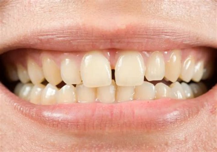 Does Madonna have a gap in her teeth?