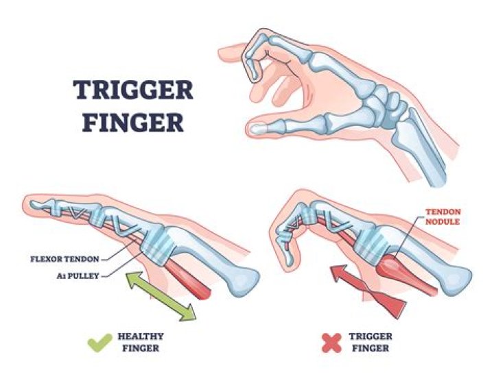 Does MS cause trigger finger?