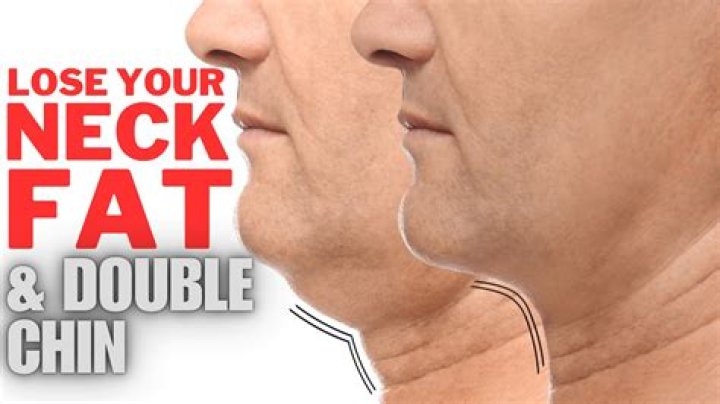 Does neck fat go away?