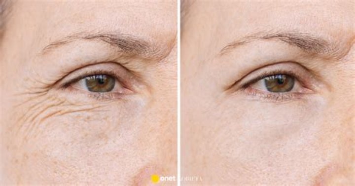 Does olive oil reduce wrinkles?