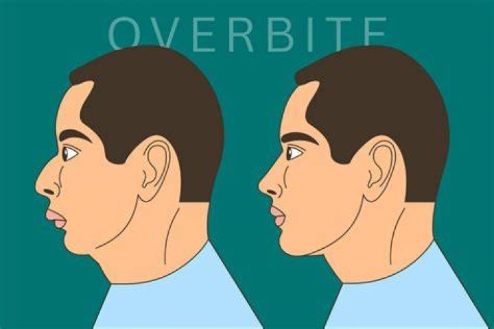 Does overbite affect smile?