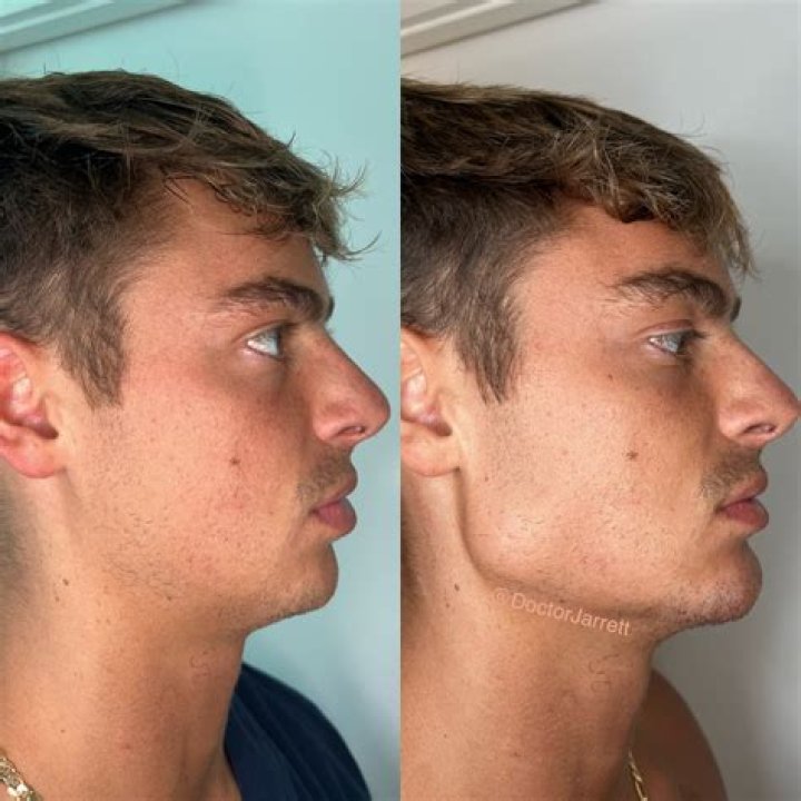 Does removing teeth affect jawline?