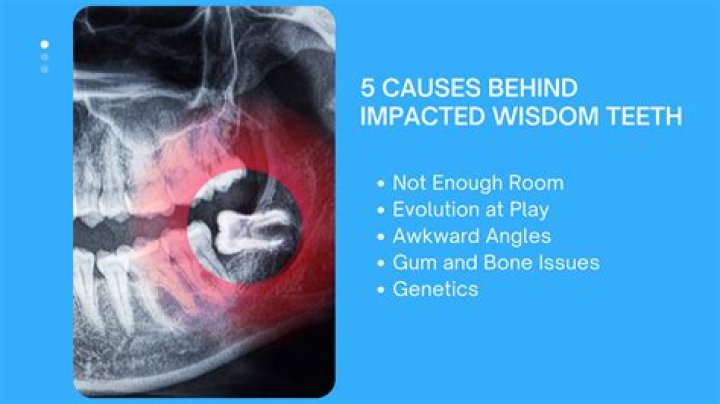 Does removing wisdom teeth affect brain?