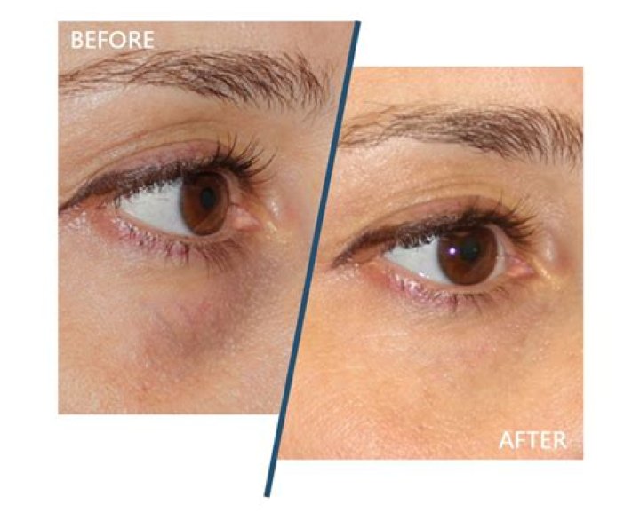 Does retinol help under eye hollows?