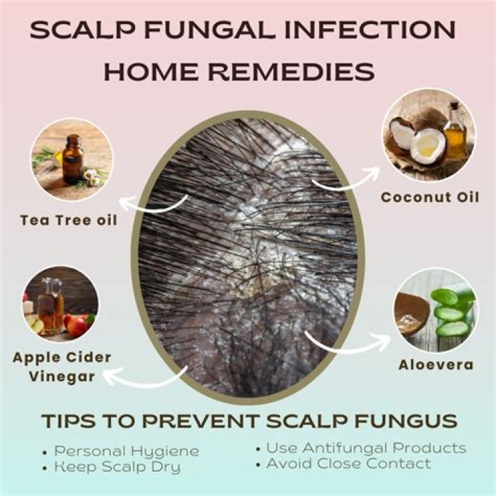 Does steroid cream treat fungal infection?