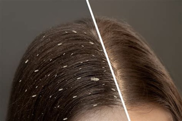 Does straightening hair get rid of lice?