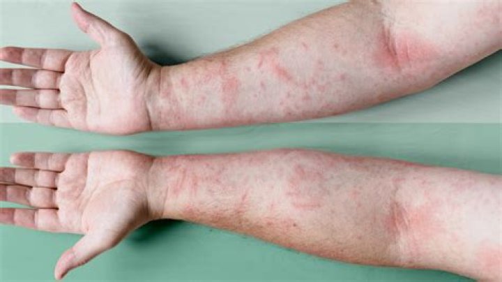 Does sugar trigger eczema?