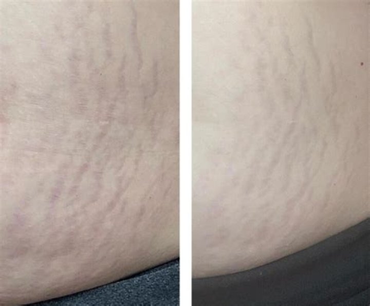 Does VapoRub help stretch marks?