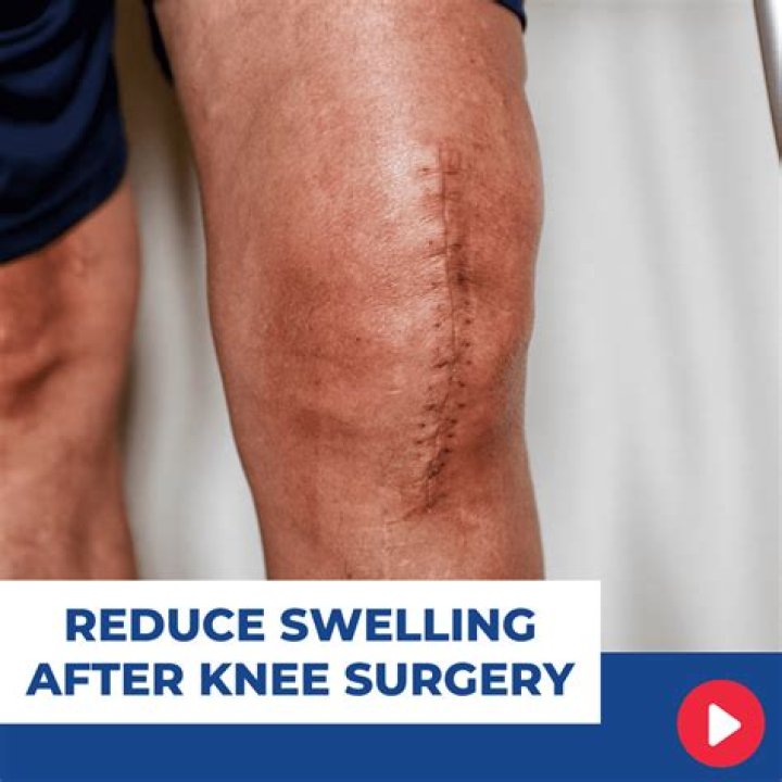 Does walking reduce swelling after surgery?