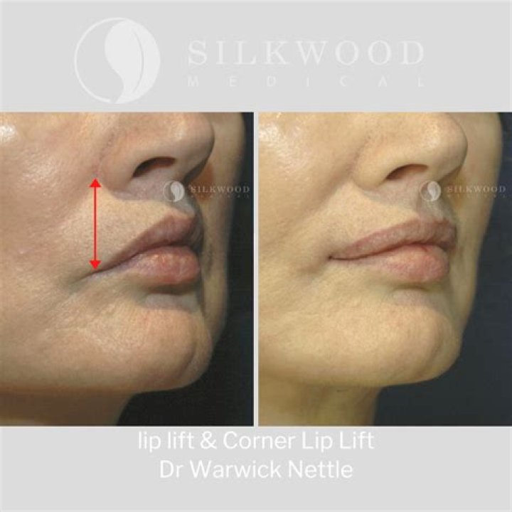 Does your nose swell after lip lift?