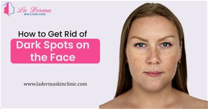 How can I get rid of dark spots on my face in 2 days?