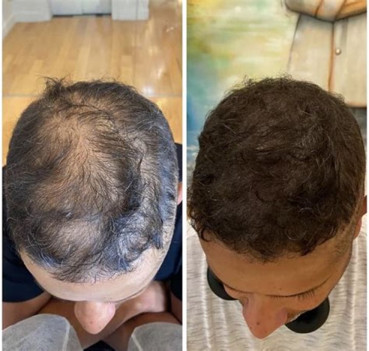 How can I hide my scalp with thin hair?