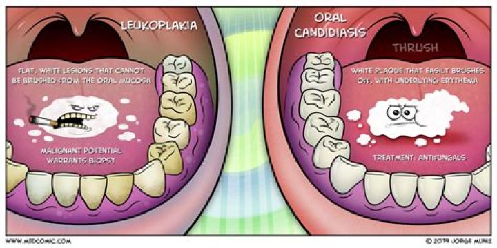 How can you distinguish between oral candidiasis and leukoplakia?