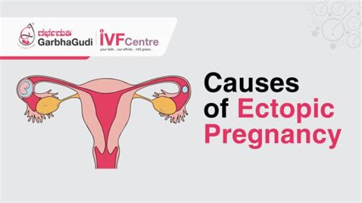 How can you rule out an ectopic pregnancy?