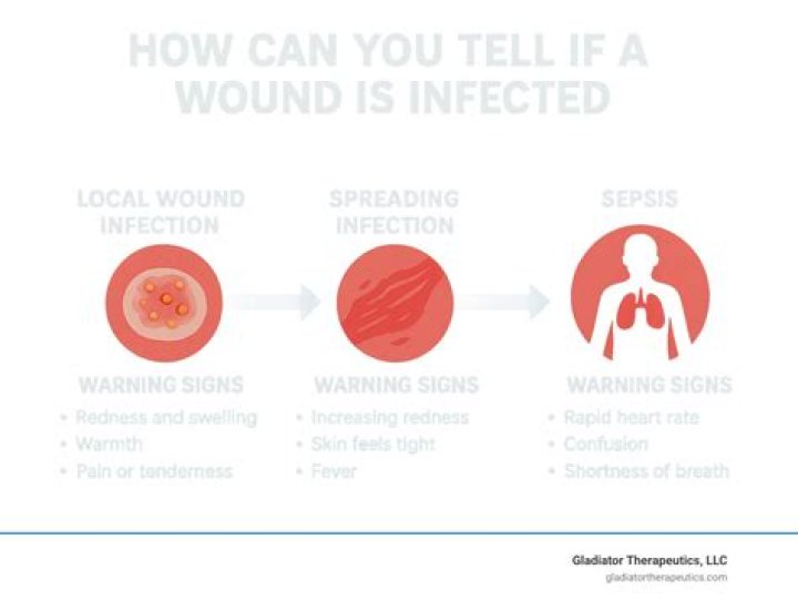How can you tell if a wound is septic?