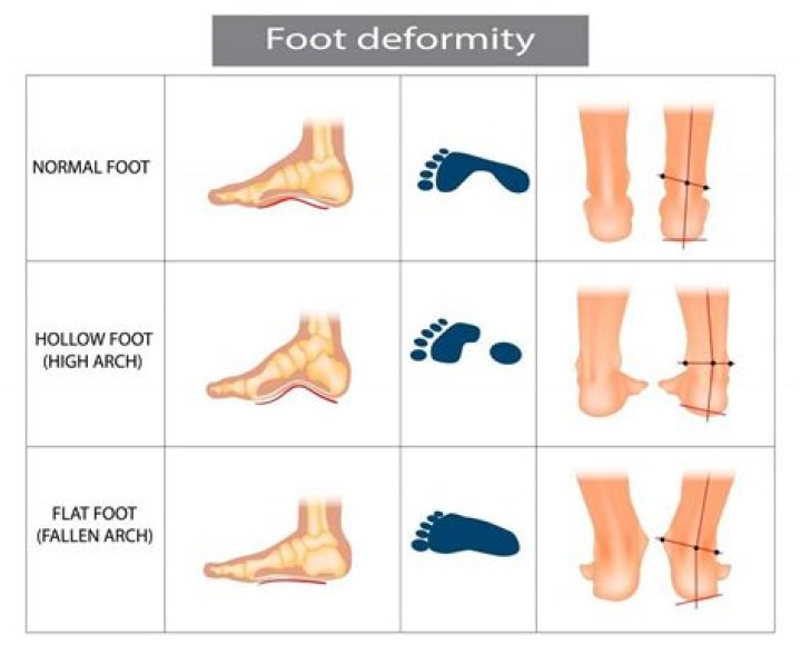 How can you tell if someone is flat footed?