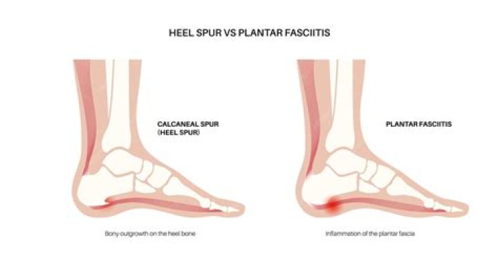 How can you tell the difference between a heel spur and a plantar fasciitis?