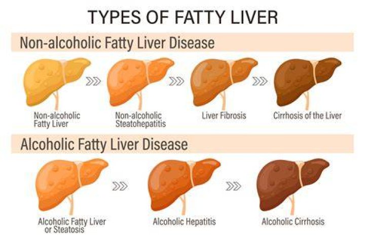 How can you tell the difference between fatty liver and cirrhosis?