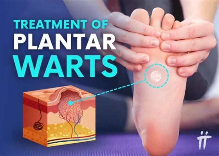 How contagious are common warts?
