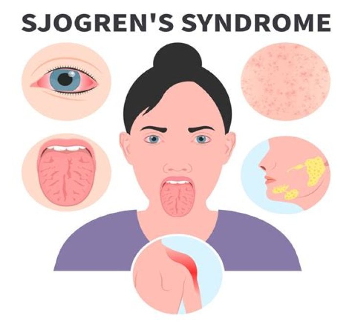 How did I get Sjogren's syndrome?