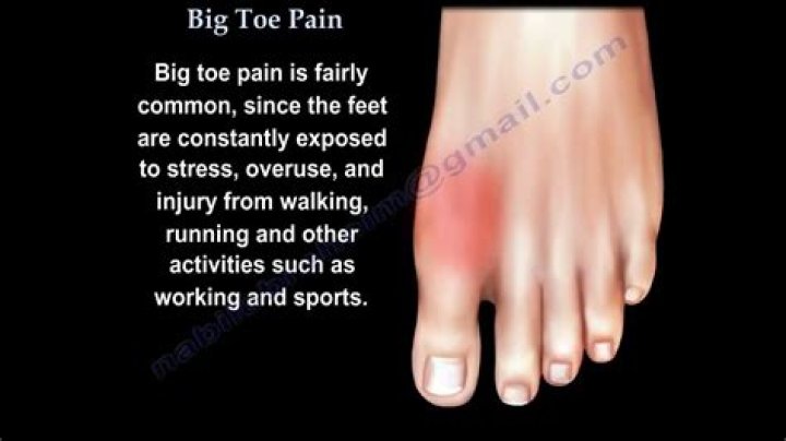 How do I get my range of motion back in my big toe?