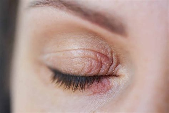 How do I get rid of the crust on my eyelids?