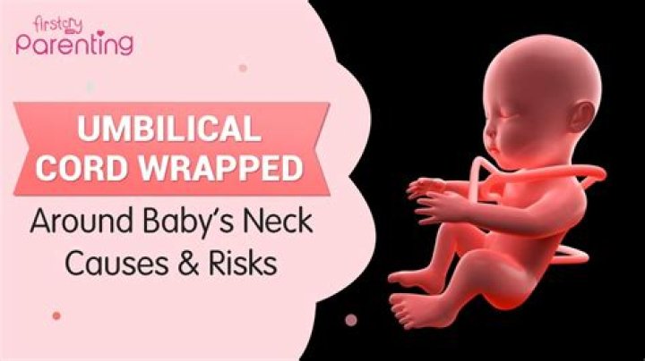 How do I keep my baby from wrapping the umbilical cord?