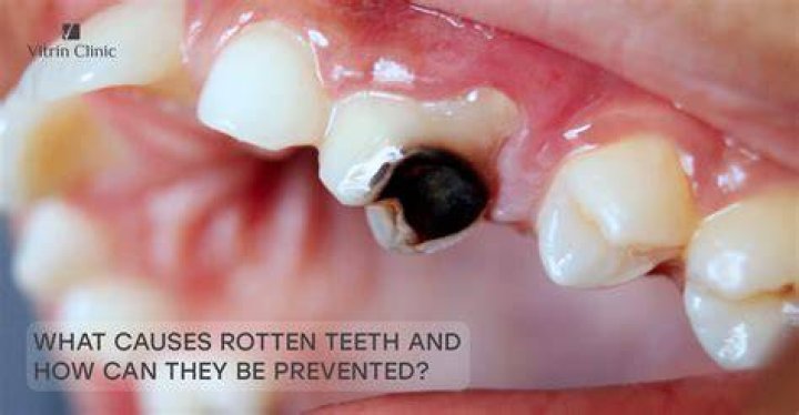 How do I stop my teeth from rotting?