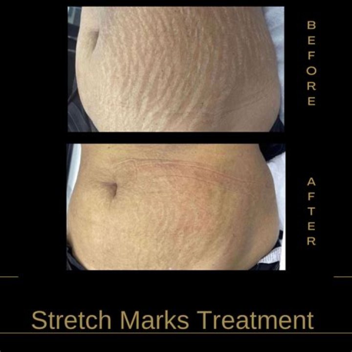 How do models not have stretch marks after pregnancy?