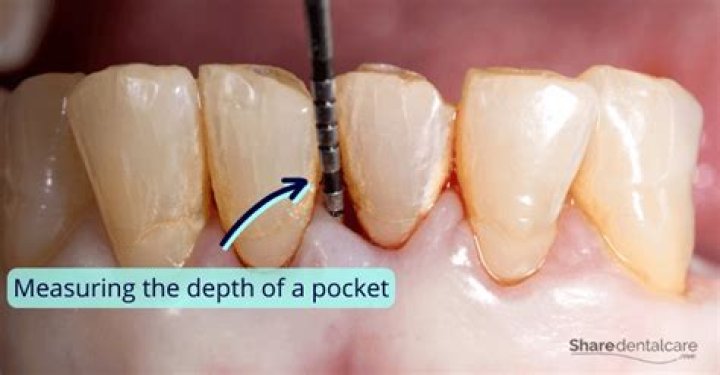 How do they fix deep periodontal pockets?