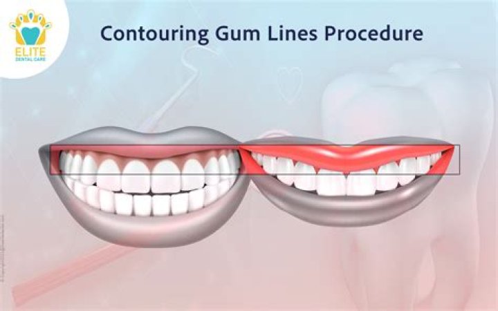 How do you clean gum lines?