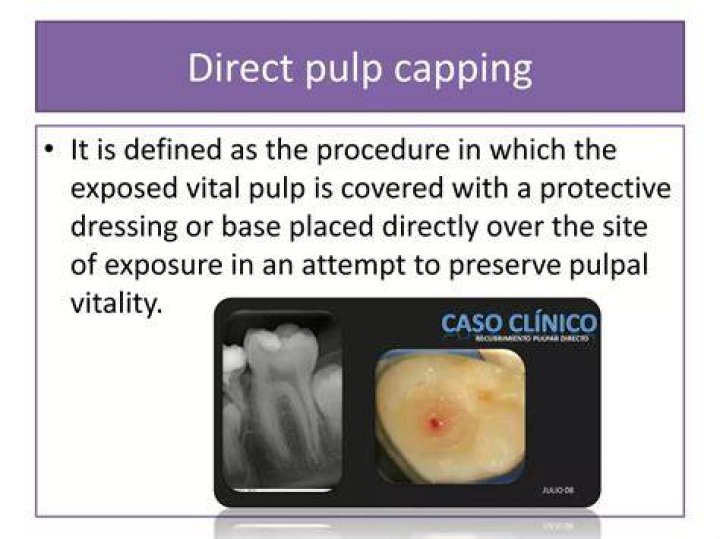 How do you do pulp capping?
