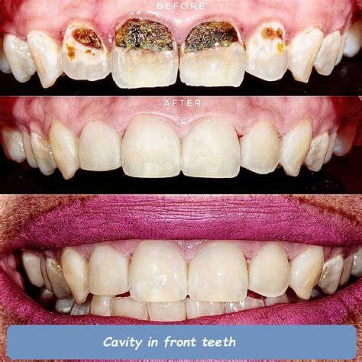 How do you fill a cavity naturally?