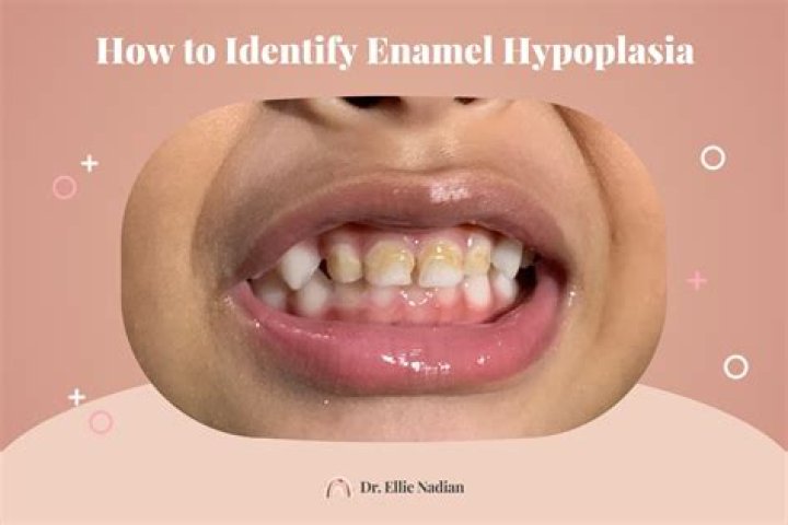 How do you fix enamel hypoplasia in kids?