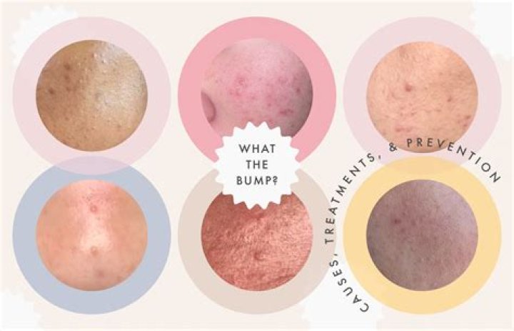 How do you get rid of clogged pores overnight?