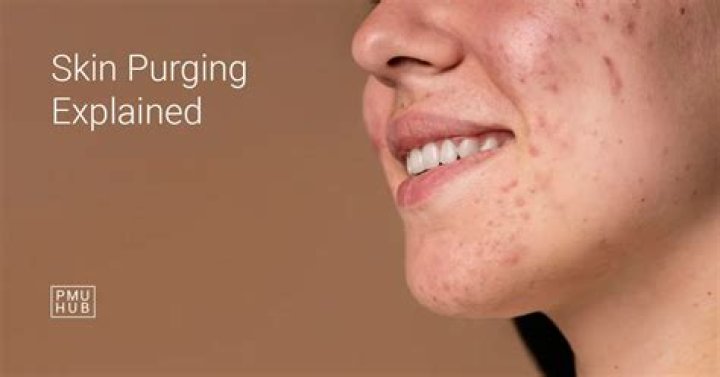 How do you get rid of skin purging?