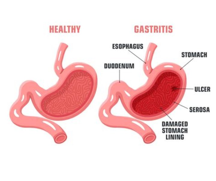 How do you know when gastritis is gone?