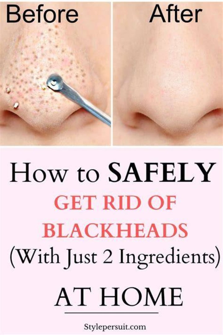 How do you manually remove blackheads?