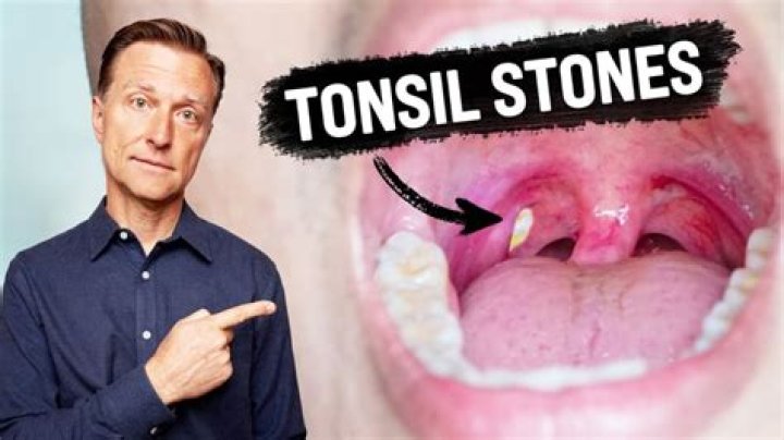 How do you push out a tonsil stone?