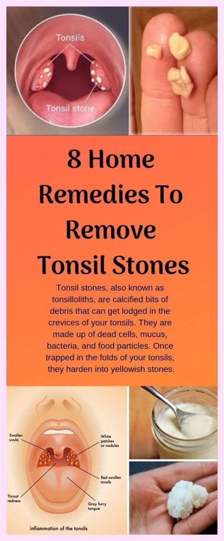 How do you remove tonsils at home?