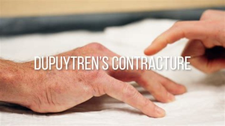 How do you slow down Dupuytren's contracture?