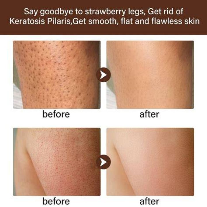 How do you stop strawberry legs?