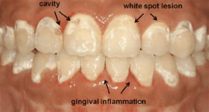 How do you stop white spots from spreading?