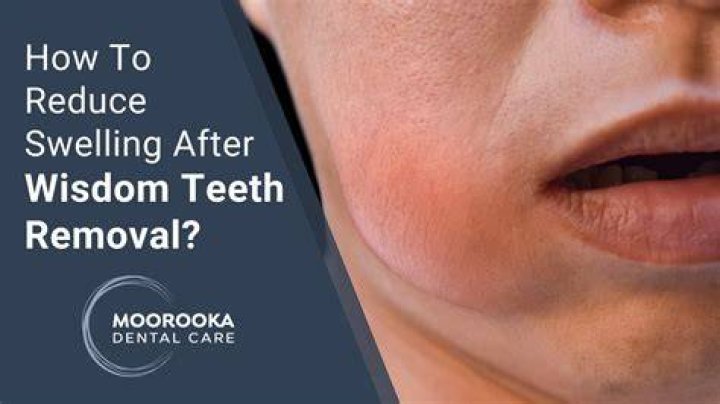 How do you swallow after wisdom teeth removal?