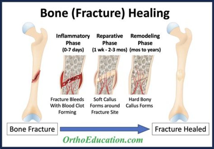 How do you tell if a fracture is healing?