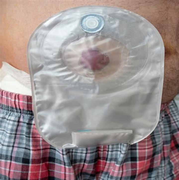 How do you tell if a stoma is infected?