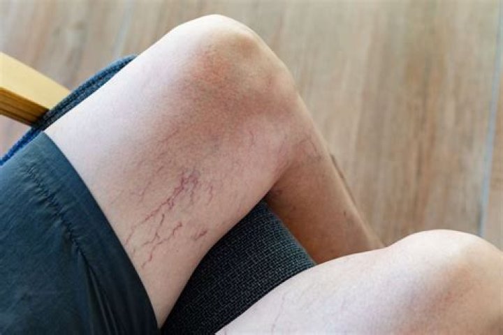 How do you treat a blood clot in the leg at home?