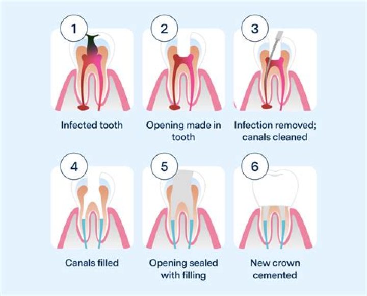 How do you treat a root canal infection?