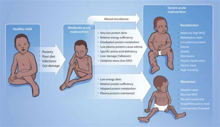 How does malnutrition affect a child?