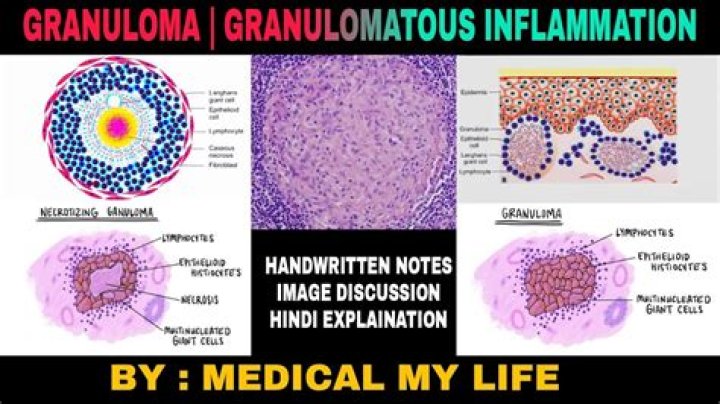 How fast do granulomas grow?